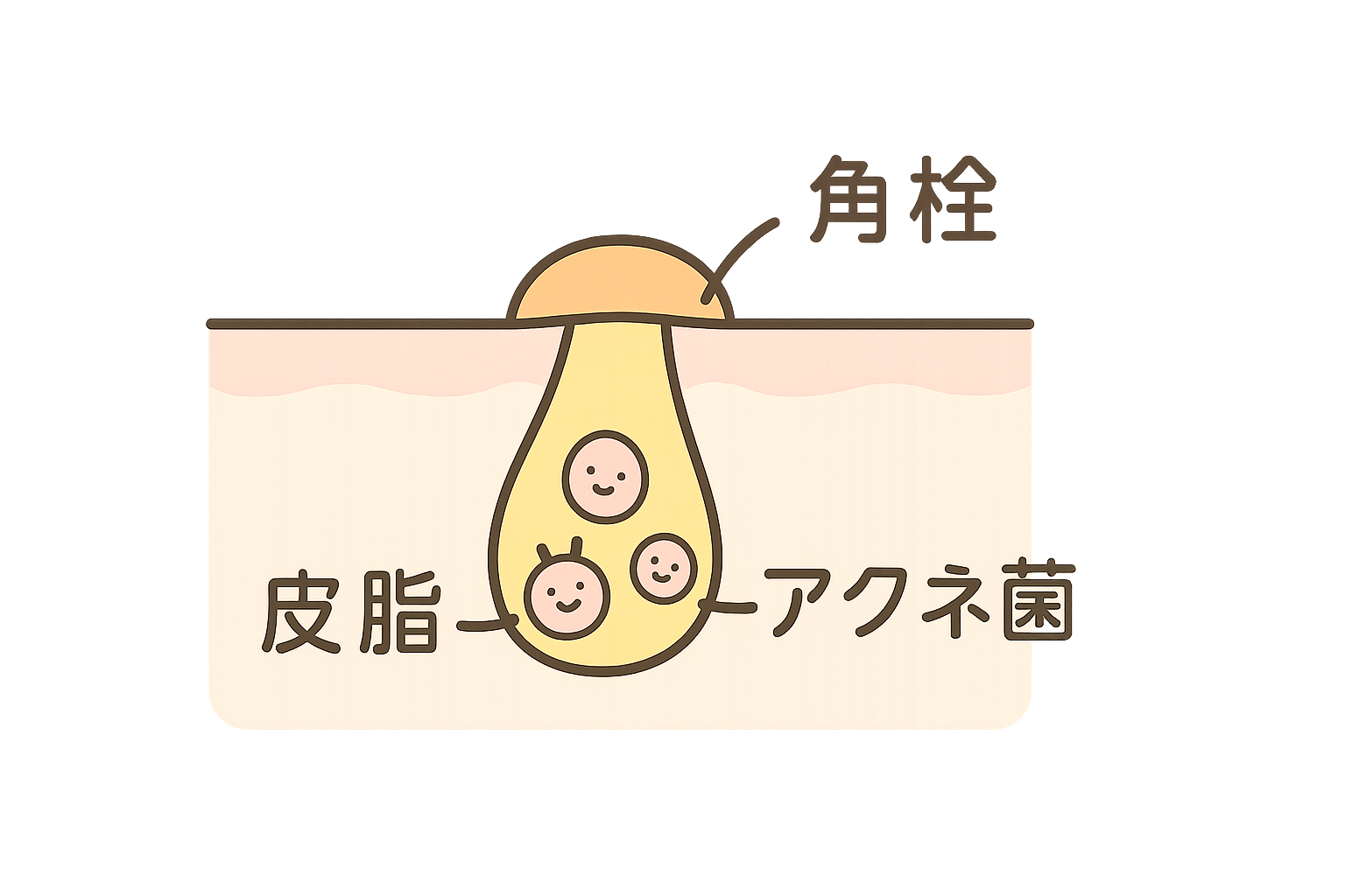 毛穴づまりとアクネ菌""